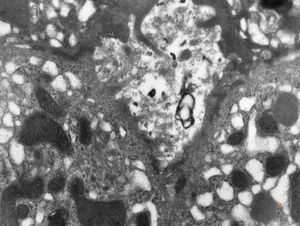 F,3y. | extracellular cholestasis- dilated primary bile duct filled withgranular material F,3y. | extracellular cholestasis- dilated primary bile duct filled withgranular material